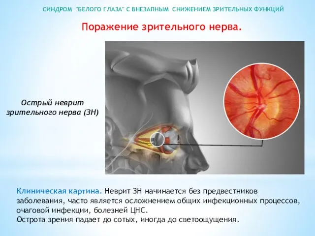 СИНДРОМ "БЕЛОГО ГЛАЗА" С ВНЕЗАПНЫМ СНИЖЕНИЕМ ЗРИТЕЛЬНЫХ ФУНКЦИЙ Поражение зрительного нерва.