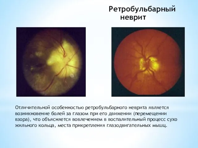 Отличительной особенностью ретробульбарного неврита является возникновение болей за глазом при его