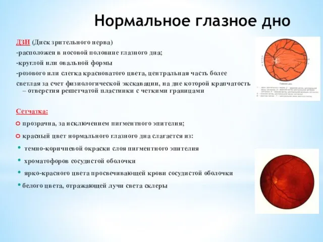 Нормальное глазное дно ДЗН (Диск зрительного нерва) -расположен в носовой половине