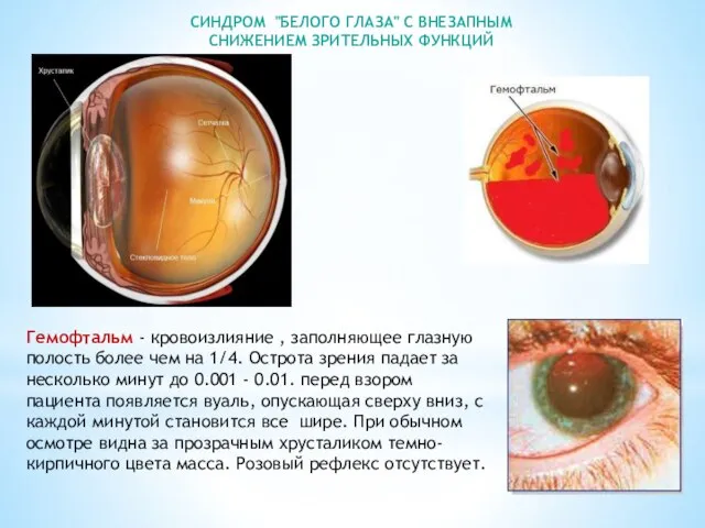 Гемофтальм - кровоизлияние , заполняющее глазную полость более чем на 1/4.
