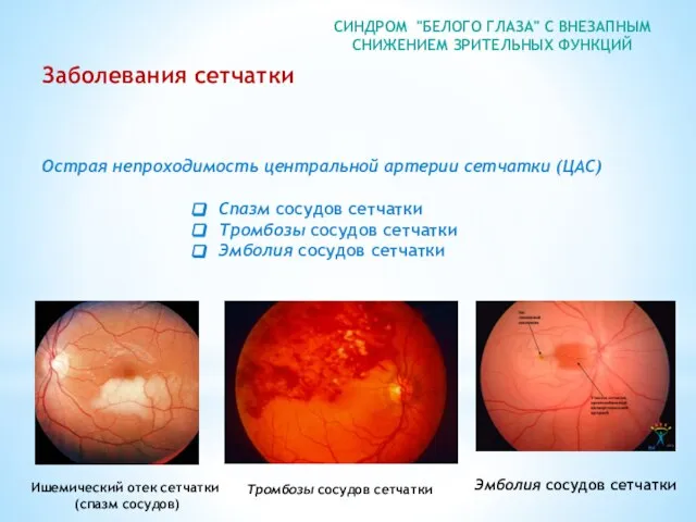 СИНДРОМ "БЕЛОГО ГЛАЗА" С ВНЕЗАПНЫМ СНИЖЕНИЕМ ЗРИТЕЛЬНЫХ ФУНКЦИЙ Заболевания сетчатки Спазм