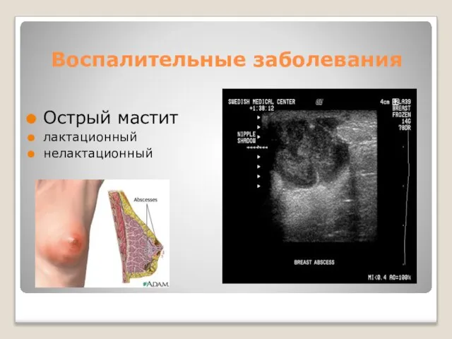 Воспалительные заболевания Острый мастит лактационный нелактационный