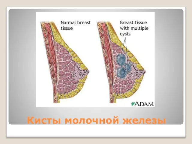 Кисты молочной железы