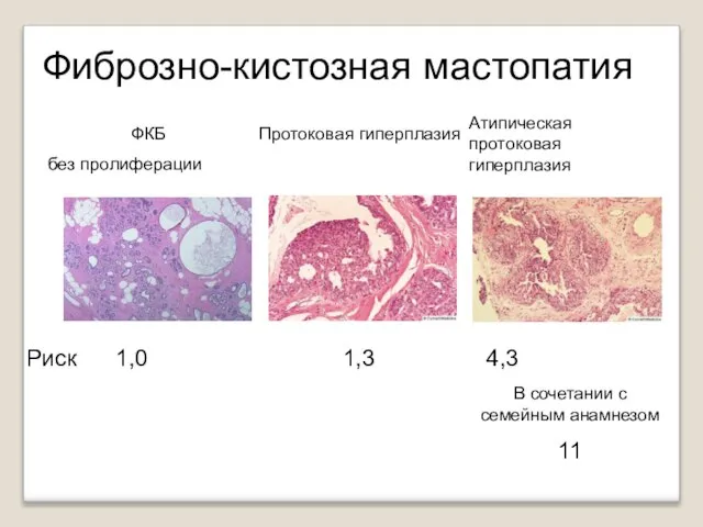 Фиброзно-кистозная мастопатия Риск 1,0 1,3 4,3 ФКБ без пролиферации Протоковая гиперплазия