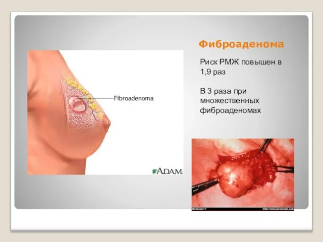 Фиброаденома Риск РМЖ повышен в 1,9 раз В 3 раза при множественных фиброаденомах