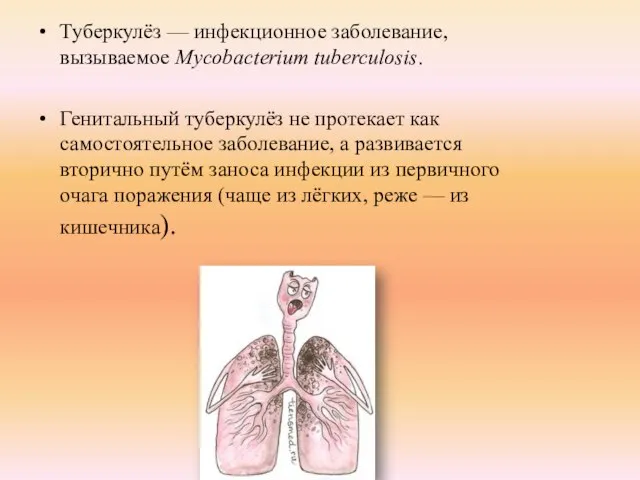 Туберкулёз — инфекционное заболевание, вызываемое Mycobacterium tuberculosis. Генитальный туберкулёз не протекает