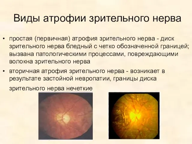 Виды атрофии зрительного нерва простая (первичная) атрофия зрительного нерва - диск