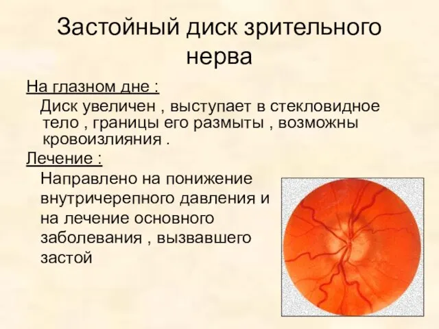 Застойный диск зрительного нерва На глазном дне : Диск увеличен ,