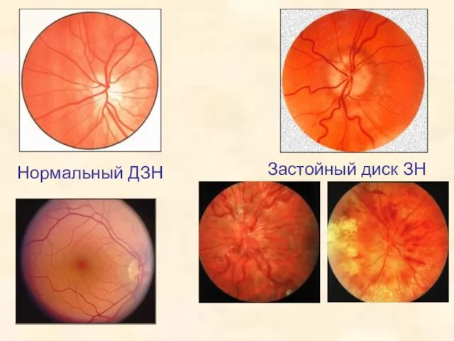 Застойный диск ЗН Нормальный ДЗН