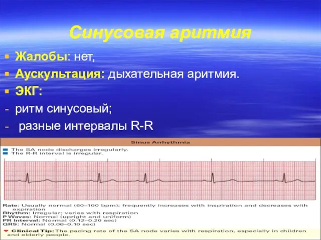 Синусовая аритмия Жалобы: нет, Аускультация: дыхательная аритмия. ЭКГ: ритм синусовый; разные интервалы R-R