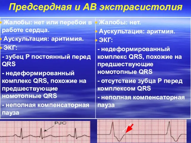 Предсердная и АВ экстрасистолия