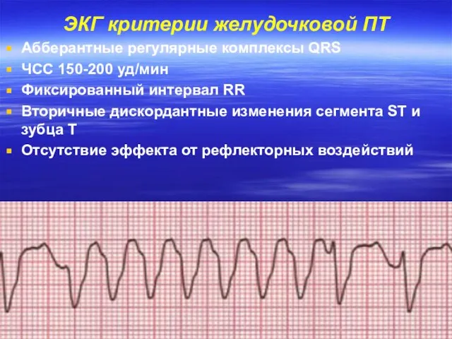 ЭКГ критерии желудочковой ПТ Абберантные регулярные комплексы QRS ЧСС 150-200 уд/мин