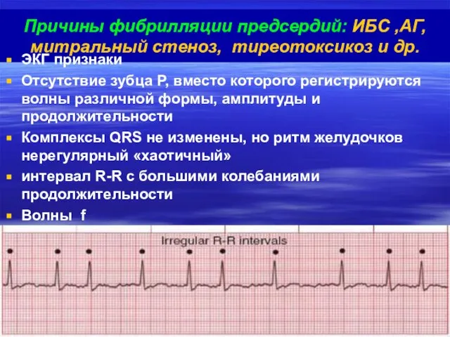 Причины фибрилляции предсердий: ИБС ,АГ, митральный стеноз, тиреотоксикоз и др. ЭКГ