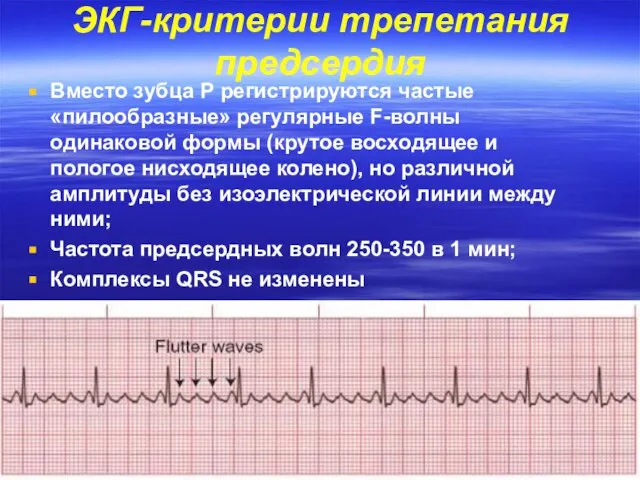 ЭКГ-критерии трепетания предсердия Вместо зубца Р регистрируются частые «пилообразные» регулярные F-волны