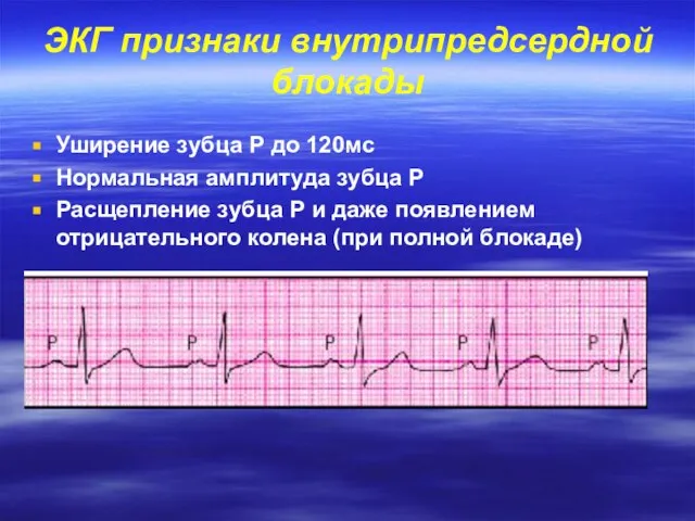 ЭКГ признаки внутрипредсердной блокады Уширение зубца Р до 120мс Нормальная амплитуда