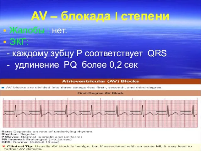 AV – блокада степени Жалобы : нет. ЭКГ: - каждому зубцу