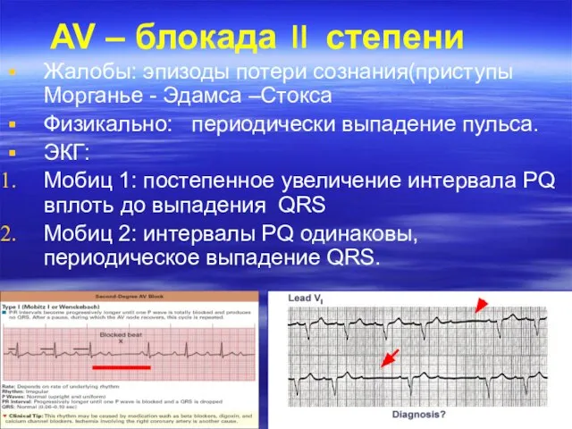 AV – блокада степени Жалобы: эпизоды потери сознания(приступы Морганье - Эдамса