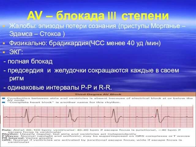 AV – блокада степени Жалобы: эпизоды потери сознания (приступы Морганье –Эдамса