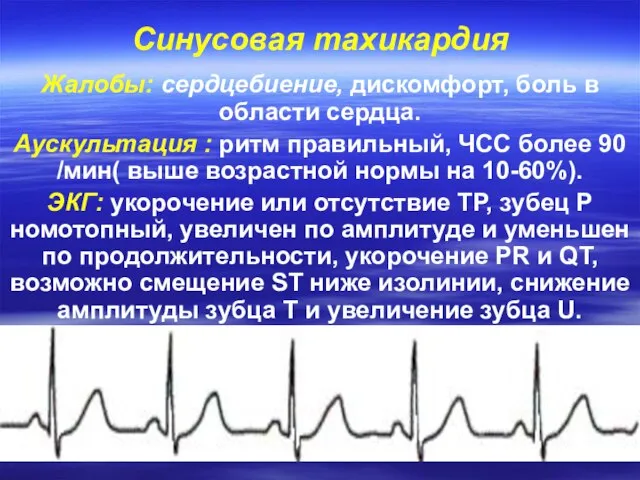 Синусовая тахикардия Жалобы: сердцебиение, дискомфорт, боль в области сердца. Аускультация :