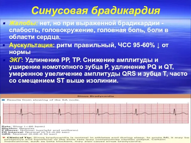 Синусовая брадикардия Жалобы: нет, но при выраженной брадикардии -слабость, головокружение, головная