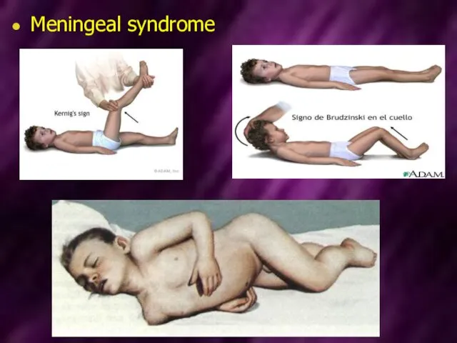 Meningeal syndrome