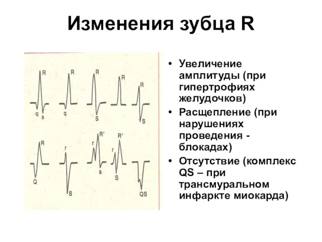 Изменения зубца R Увеличение амплитуды (при гипертрофиях желудочков) Расщепление (при нарушениях