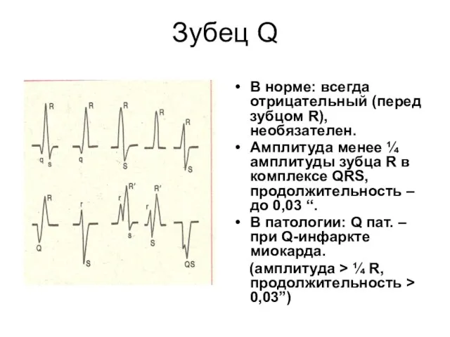 Зубец Q В норме: всегда отрицательный (перед зубцом R), необязателен. Амплитуда