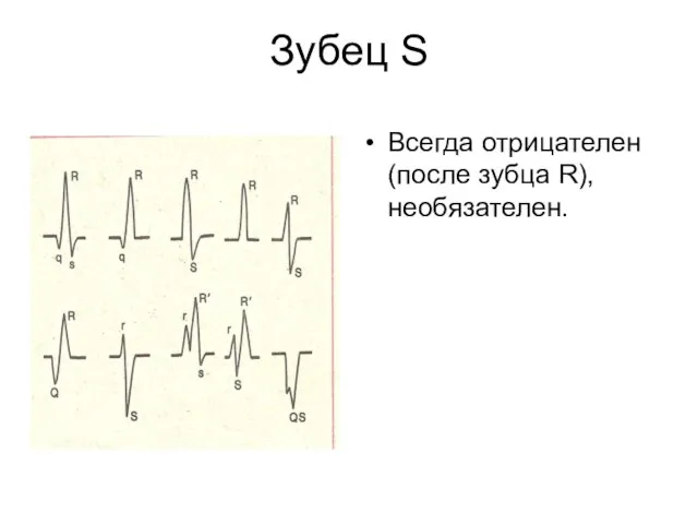 Зубец S Всегда отрицателен (после зубца R), необязателен.