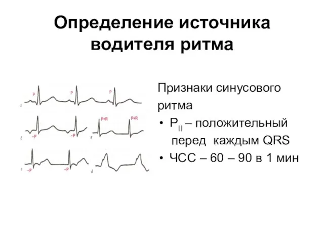 Определение источника водителя ритма Признаки синусового ритма РII – положительный перед