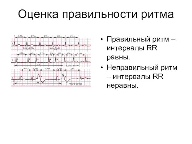 Оценка правильности ритма Правильный ритм – интервалы RR равны. Неправильный ритм – интервалы RR неравны.