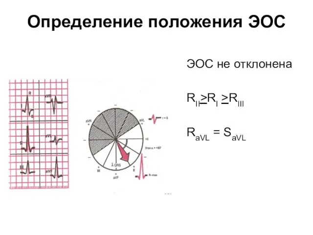 Определение положения ЭОС ЭОС не отклонена RII>RI >RIII RaVL = SaVL