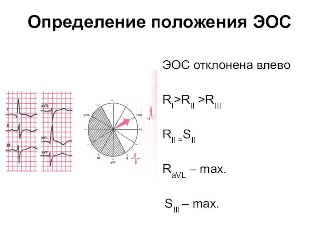 Определение положения ЭОС ЭОС отклонена влево RI>RII >RIII RII =SII RaVL – max. SIII – max.