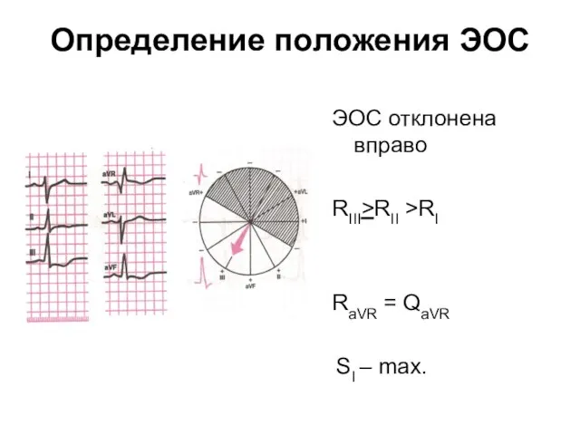 Определение положения ЭОС ЭОС отклонена вправо RIII>RII >RI RaVR = QaVR SI – max.