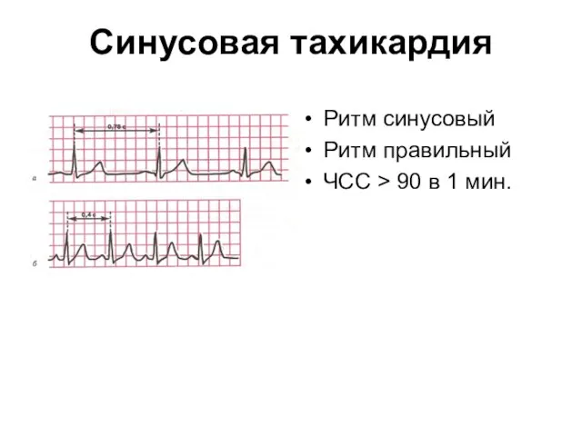 Синусовая тахикардия Ритм синусовый Ритм правильный ЧСС > 90 в 1 мин.