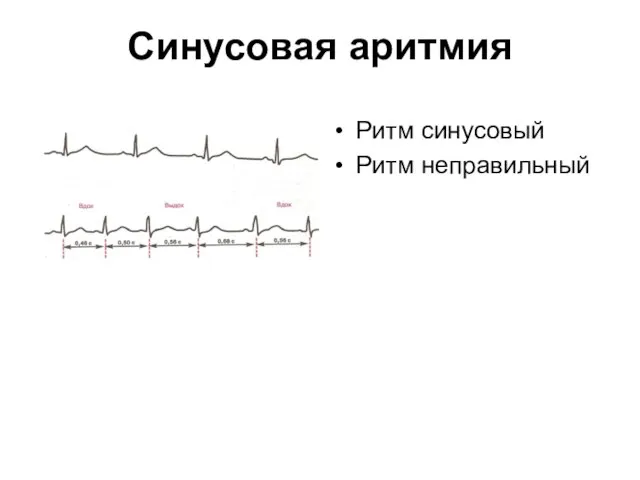 Cинусовая аритмия Ритм синусовый Ритм неправильный