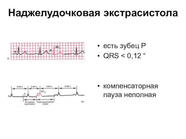 Наджелудочковая экстрасистола есть зубец Р QRS компенсаторная пауза неполная