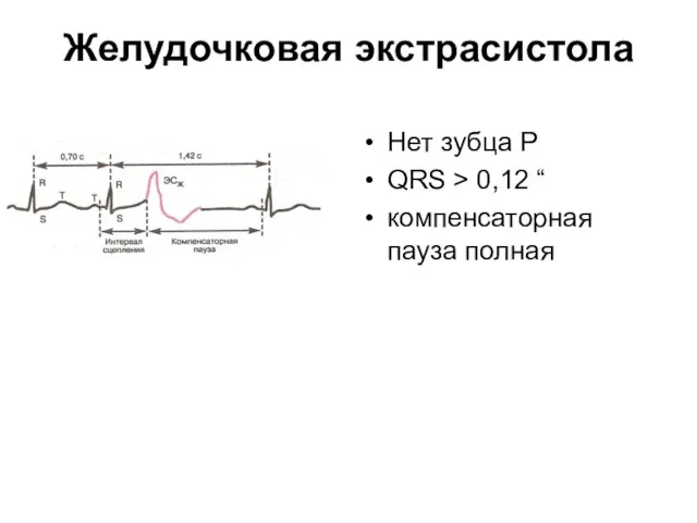 Желудочковая экстрасистола Нет зубца Р QRS > 0,12 “ компенсаторная пауза полная