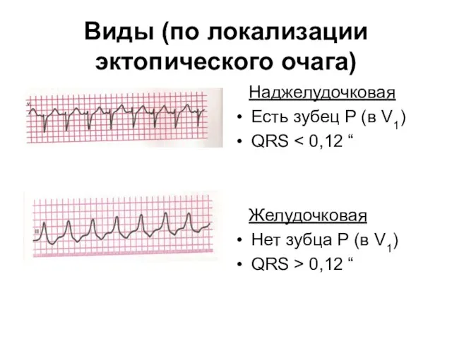 Виды (по локализации эктопического очага) Наджелудочковая Есть зубец Р (в V1)
