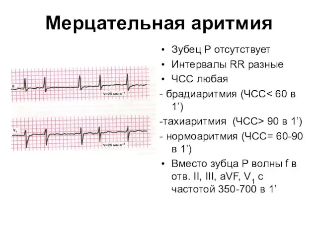 Мерцательная аритмия Зубец Р отсутствует Интервалы RR разные ЧСС любая -