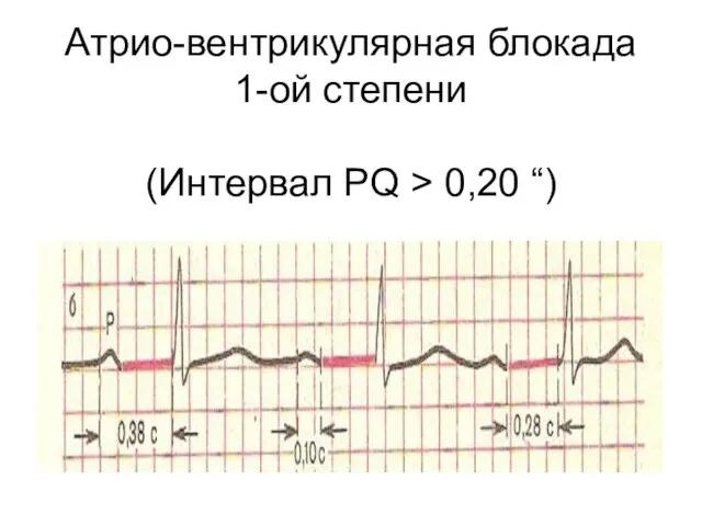 Атрио-вентрикулярная блокада 1-ой степени (Интервал РQ > 0,20 “)