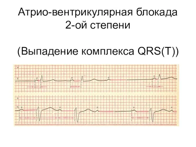 Атрио-вентрикулярная блокада 2-ой степени (Выпадение комплекса QRS(T))