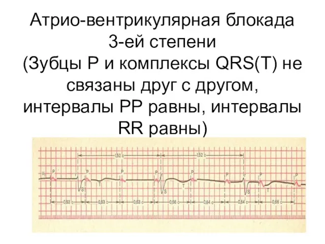 Атрио-вентрикулярная блокада 3-ей степени (Зубцы Р и комплексы QRS(T) не связаны