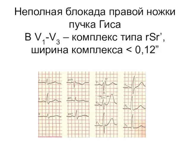 Неполная блокада правой ножки пучка Гиса В V1-V3 – комплекс типа rSr’, ширина комплекса