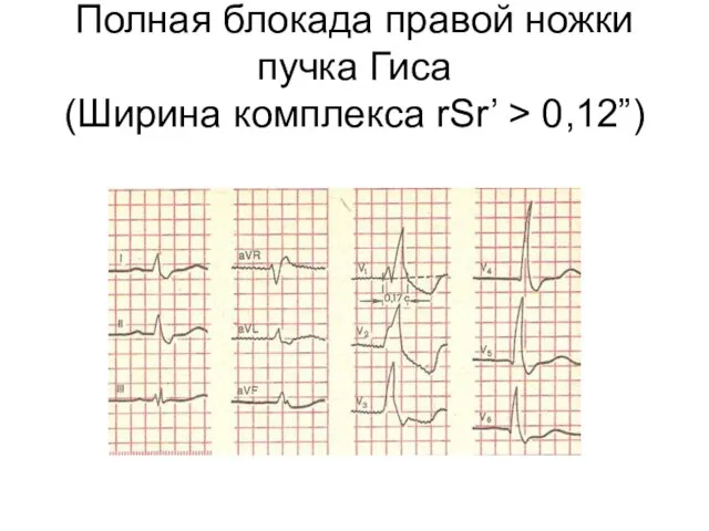 Полная блокада правой ножки пучка Гиса (Ширина комплекса rSr’ > 0,12”)