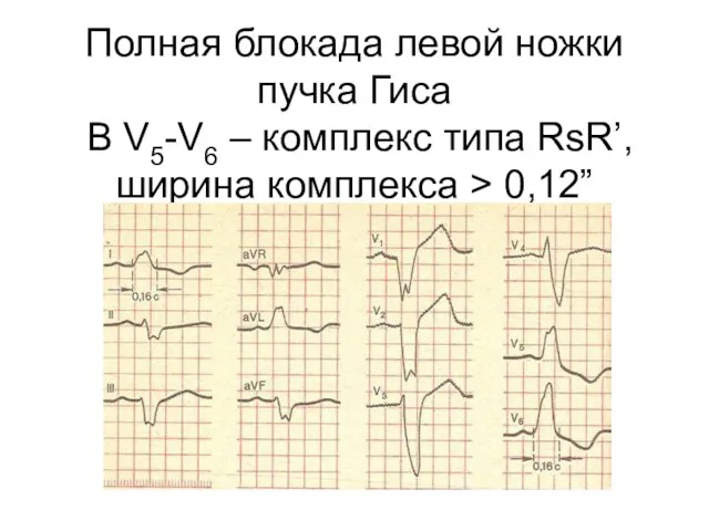 Полная блокада левой ножки пучка Гиса В V5-V6 – комплекс типа RsR’, ширина комплекса > 0,12”