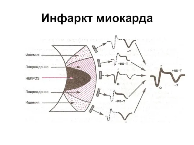 Инфаркт миокарда