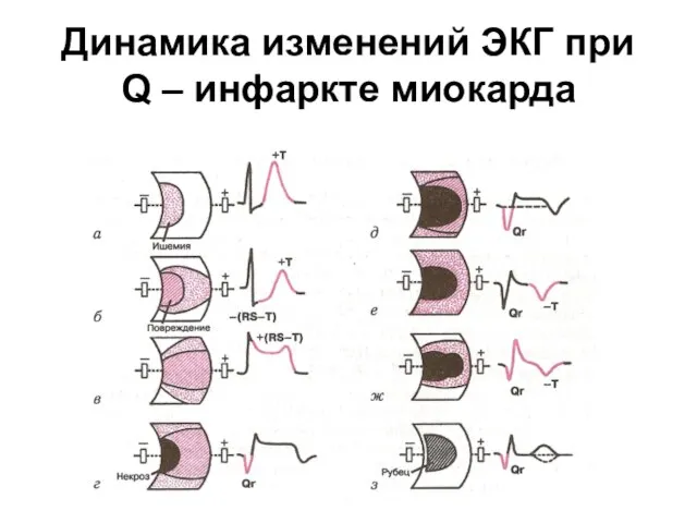 Динамика изменений ЭКГ при Q – инфаркте миокарда