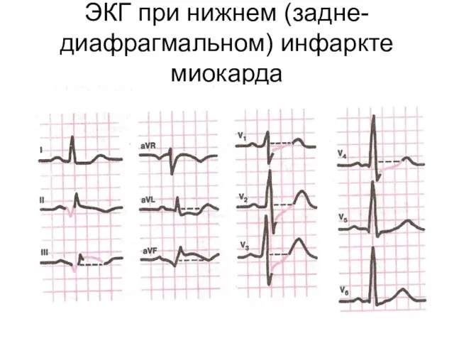 ЭКГ при нижнем (задне-диафрагмальном) инфаркте миокарда