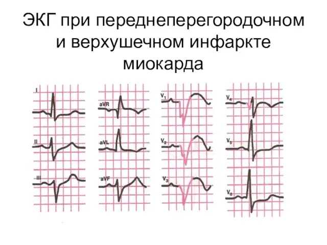 ЭКГ при переднеперегородочном и верхушечном инфаркте миокарда