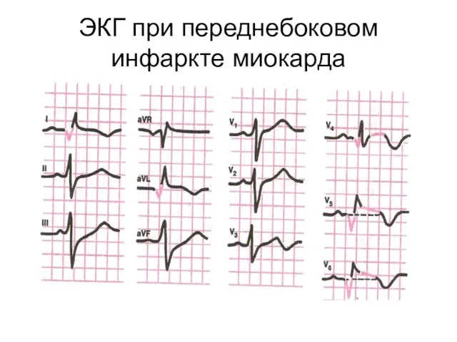 ЭКГ при переднебоковом инфаркте миокарда